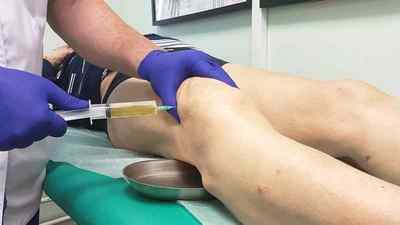 Бурсит гусячої лапки колінного суглоба: симптоми і лікування запалення гусячої лапки в коліні, анзеріновой бурсит що це таке | Ревматолог