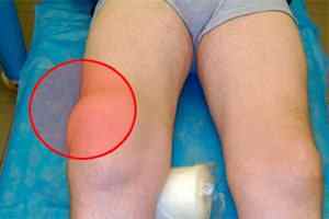 Бурсит колінних суглобів: симптоми і лікування, фото, що це таке, медикаментозне лікування, причини, хронічний бурсит | Ревматолог