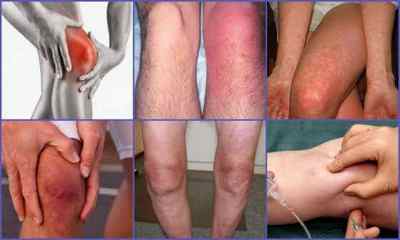 Бурсит колінного суглоба - симптоми і лікування, фото