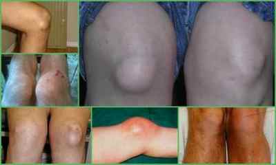 Бурсит колінного суглоба - симптоми і лікування, фото