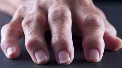 Бурсит пальця руки і ноги: симптоми і лікування кисті і фаланги, як лікувати бурсит запястя в домашніх умовах, великого пальця стопи | Ревматолог