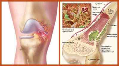 Бурсит тазостегнового суглоба: симптоми і медикаментозне лікування, як лікувати вертельной бурсит, суглобова сумка | Ревматолог