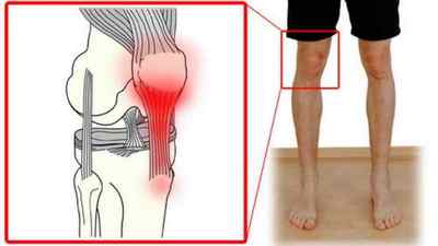 Бурсит тазостегнового суглоба: симптоми і медикаментозне лікування, як лікувати вертельной бурсит, суглобова сумка | Ревматолог