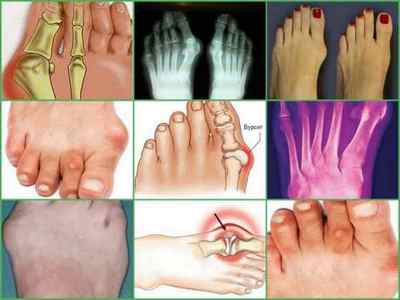 Бурсит великого пальця стопи: симптоми, лікування, фото