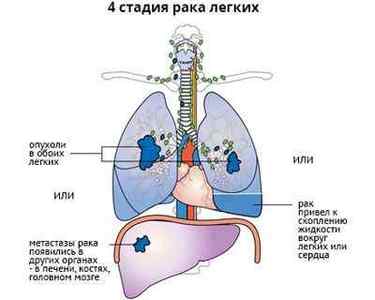 Центральний рак легені: стадії, прогноз, методи лікування