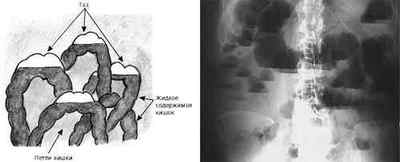 Чаші Клойбера на рентгенограмі: як проявляються і на що вказують?