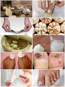 Часник від грибка нігтів на ногах - рецепти і відгуки