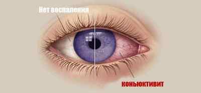 Червоні очі: причини і лікування почервоніння народними засобами, чому почервонів білок очей