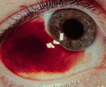 Червоні очі: причини і лікування почервоніння народними засобами, чому почервонів білок очей