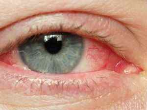 Червоні очі: причини почервоніння очного яблука, чому червоніють (від компютера, алкоголю, хвороби)