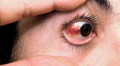 Червоні очі: причини почервоніння очного яблука, чому червоніють (від компютера, алкоголю, хвороби)