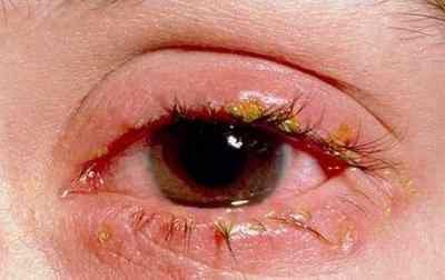 Червоні очі після сну: причини, чому червоніють білки очей вранці