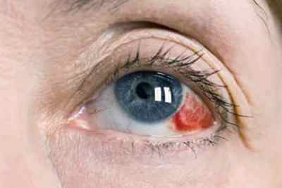Червоні очі після сну: причини, чому червоніють білки очей вранці