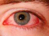 Червоні очі у дитини: причини, що робити, якщо почервонів очей, лікування