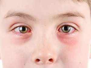 Червоні плями під очима: причини почервоніння у дитини, лікування червоних точок