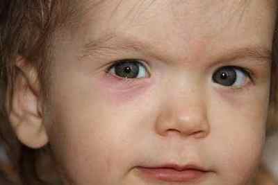 Червоні плями під очима: причини почервоніння у дитини, лікування червоних точок