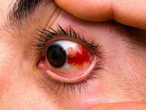 Червоне очне яблуко після удару: чим лікувати, що робити, якщо око почервонів