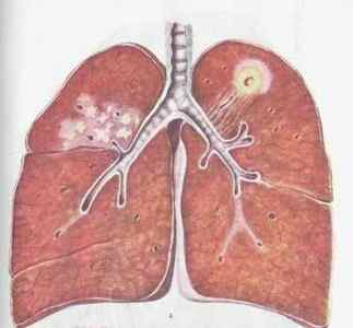 Чи можна при астмі ставити гірчичники