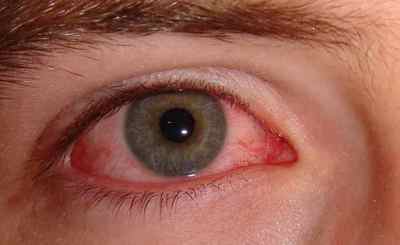 Чи можна промивати очі хлоргексидину: інструкція із застосування, як капати дитині