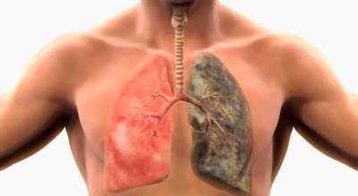 Чи можна вилікувати туберкульоз легень повністю