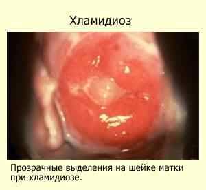 Чи можна заразитися хламідіозом, як заразитися і звідки береться хламідіоз