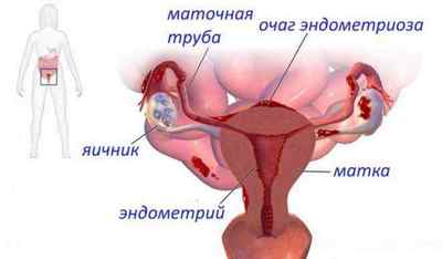 Чи можна завагітніти при ендометріозі?