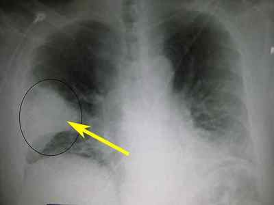 Чи покаже флюорографія запалення легенів