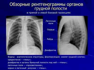 Чи показує флюорографія рак легенів - що видно на знімку
