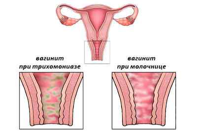 Чим корисний Метронідазол при вагините і як його приймати