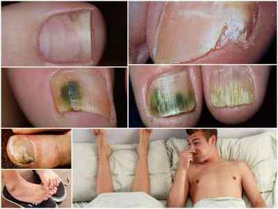 Чим лікувати грибок нігтів на ногах - ефективні методи