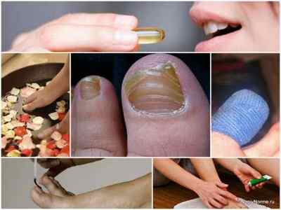 Чим лікувати грибок нігтів на ногах в домашніх умовах