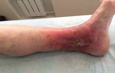 Чим лікувати трофічну виразку на нозі при варикозі