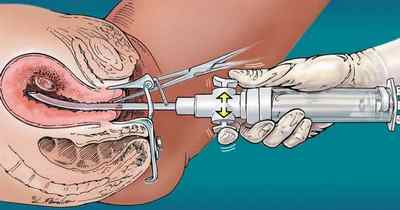 Чим небезпечна процедура аборту при ендометріозі