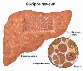 Чим небезпечний гепатит С: наслідки зараження