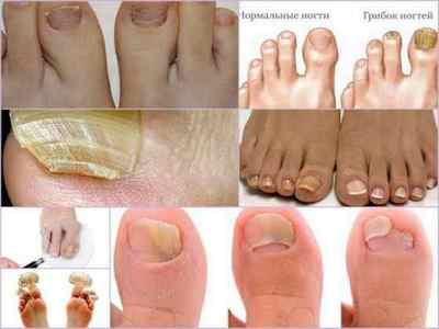 Чим небезпечний грибок нігтів на ногах якщо його не лікувати (наслідки для організму)