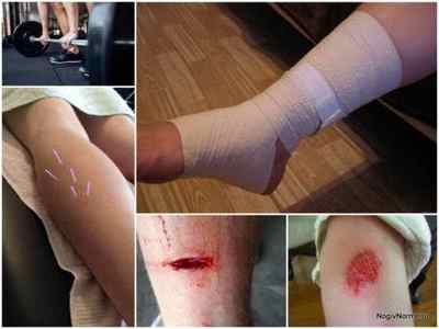 Чим небезпечний варикоз на ногах - наслідки і ускладнення у жінок і чоловіків