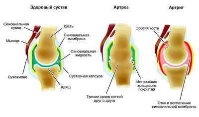 Чим відрізняється артроз від артриту колінного, гомілковостопного суглобів та кистей рук, різниця і як визначити | Ревматолог