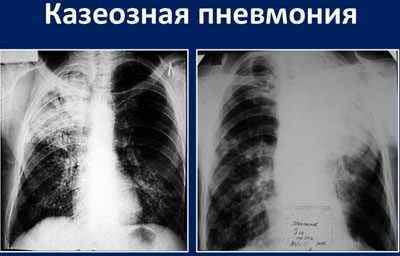 Чим відрізняється пневмонія від туберкульозу і чи може одне перейти в інше