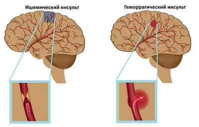 Чим відрізняється ішемічний інсульт від геморагічного