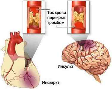 Чим відрізняються інсульти від інфарктів і які загальні ознаки