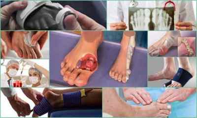 Чим і як лікувати подагру на великому пальці ноги