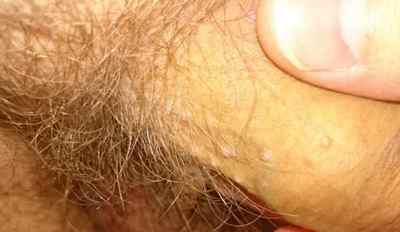 Чиряк на пенісі: фото, симптоми, методи лікування та заходи профілактики фурункулів на чоловічому статевому члені