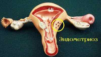 Чистка матки (вишкрібання) при ендометріозі
