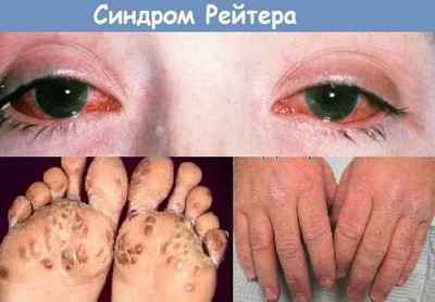 Chlamydia trachomatis: симптоми, лікування, діагностика