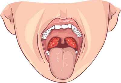 Чому болить горло - можливі причини патології