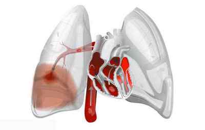 Чому може виникнути набряк легенів при інфаркті міокарда і яке лікування можливо