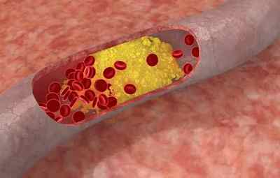 Чому підвищений холестерин в крові