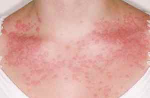 Чому виникає алергія на синтетику