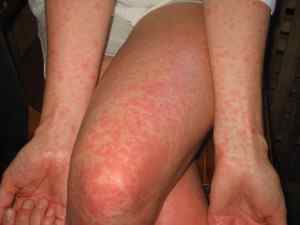 Чому виникає алергія на солярій
