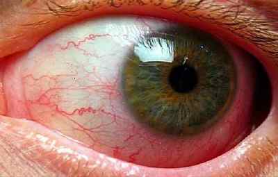 Чому виникає звуження судин очного дна і як його лікувати